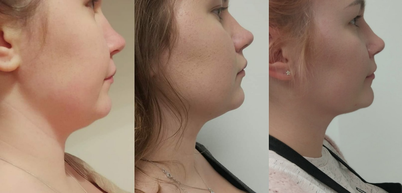 🔬 LIPO LAX VL – Trattamento Mesoterapico Avanzato per il Rimodellamento del Viso