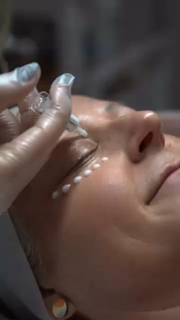 Applicazione manuale del Bio Microneedling con spicole sul viso